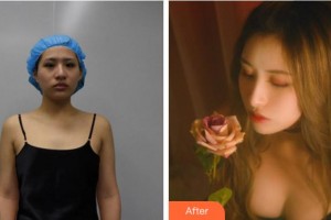 麗水慈愛醫(yī)院整形美容中心樸永佑整形價格表附自體脂肪隆胸案例展示