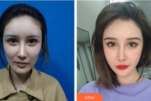 四川美萊醫(yī)學美容醫(yī)院夏秋整形價格表附埋線提升案例展示