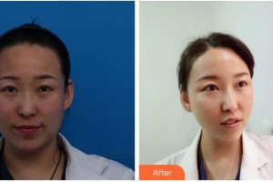 四川西嬋整形美容醫(yī)院蒲興旺整形價格表附埋線提升案例展示