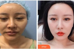 四川西嬋整形美容醫(yī)院邵文輝整形價格表附埋線提升案例展示