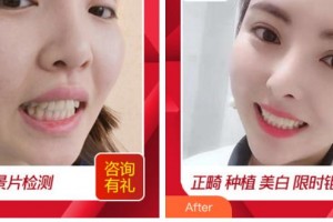 四川西嬋整形美容醫(yī)院謝文揚教授整形價格表附貴金屬烤瓷牙案例展示