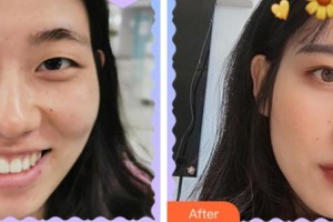 四川西嬋整形美容醫(yī)院肖慶昌整形價格表附眼部綜合案例展示