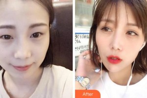 四川西嬋整形美容醫(yī)院王勇丁整形價格表附眼部綜合案例展示