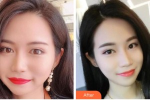 四川西嬋整形美容醫(yī)院馮彤整形價格表附埋線提升案例展示