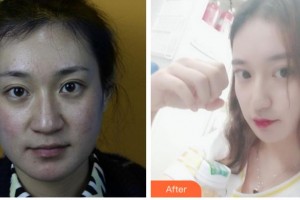 四川西嬋整形美容醫(yī)院李健寧整形價格表附熱瑪吉案例展示