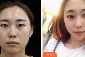 四川西嬋整形美容醫(yī)院胡杰整形價格表附熱瑪吉案例展示