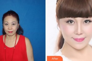 四川美萊醫(yī)學美容醫(yī)院蒙潔整形價格表附埋線提升案例展示