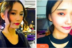 四川華美紫馨醫(yī)學美容醫(yī)院劉會省整形價格表附熱瑪吉案例展示