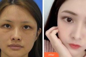 四川省人民醫(yī)院整形外科張家建整形價(jià)格表附埋線(xiàn)提升案例展示