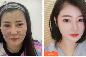 四川省人民醫(yī)院整形外科蔡震整形價(jià)格表附熱瑪吉案例展示