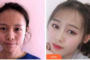 四川美萊醫(yī)學(xué)美容醫(yī)院韓國(guó)棟整形價(jià)格表附埋線(xiàn)提升案例展示