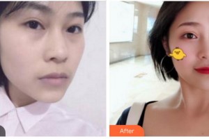 四川武警總隊(duì)醫(yī)院樂(lè)山分院燒傷整形科帥秀蓉整形價(jià)格表附埋線(xiàn)提升案例展示