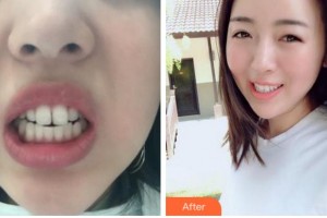 四川大學華西口腔醫(yī)院美容中心張招娣整形價格表附隱形托槽矯正案例展示