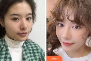 四川大學華西口腔醫(yī)院美容中心余自能整形價格表附熱瑪吉案例展示