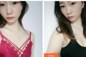 四川西嬋整形美容醫(yī)院謝凱英整形價格表附自體脂肪隆胸案例展示