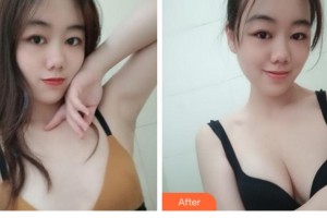 四川西嬋整形美容醫(yī)院黃亮整形價格表附自體脂肪隆胸案例展示