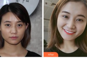 四川圣麗整形美容醫(yī)院董秀清整形價格表附埋線提升案例展示