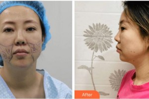 四川圣麗整形美容醫(yī)院王才惠整形價(jià)格表附埋線(xiàn)提升案例展示