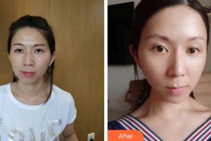 四川圣麗整形美容醫(yī)院劉晶整形價格表附熱拉提案例展示