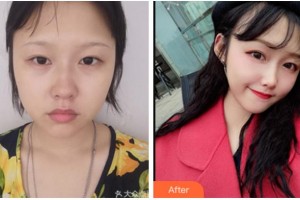 四川華人醫(yī)聯(lián)整形美容醫(yī)院郭景璽整形價格表附埋線提升案例展示