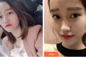 四川華人醫(yī)聯(lián)整形美容醫(yī)院朱文超整形價格表附牙齒隱形矯正案例展示