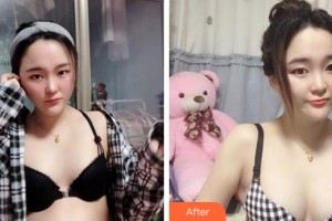 四川華人醫(yī)聯(lián)整形美容醫(yī)院蔣俊英整形價格表附自體脂肪隆胸案例展示