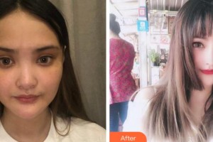 四川省紅十字腫瘤醫(yī)院整形科虞冬梅整形價格表附耳軟骨復合隆鼻案例展示