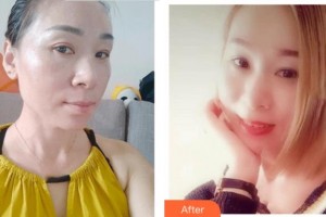 四川華美紫馨醫(yī)學(xué)美容醫(yī)院趙瓊英整形價(jià)格表附激光祛斑案例展示