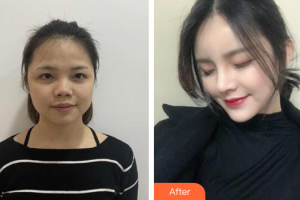 深圳蘭喬醫(yī)療美容門診部陳邦胤整形價(jià)格表附假體隆鼻墊下巴案例展示