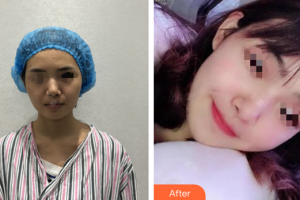 深圳奧拉克醫(yī)療美容診所柳錫鉉整形價(jià)格表附超微小氣泡案例展示