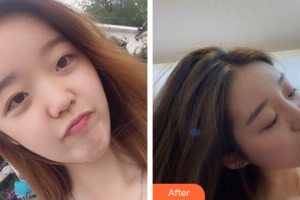 深圳瑞芙臣醫(yī)療美容門診部曾輝武整形價(jià)格表附鼻部整形案例展示