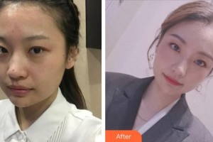 四川西嬋整形美容醫(yī)院李珺整形價(jià)格表附激光祛斑案例展示