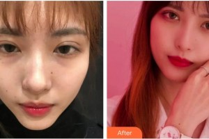 四川華美紫馨醫(yī)學(xué)美容醫(yī)院宋曉東整形價(jià)格表附激光祛斑案例展示