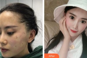 四川西嬋泛亞醫(yī)學(xué)美容醫(yī)院吳亮廷整形價(jià)格表附埋線(xiàn)提升案例展示