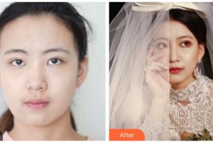 四川西嬋泛亞醫(yī)學(xué)美容醫(yī)院廖茄利整形價(jià)格表附熱瑪吉案例展示