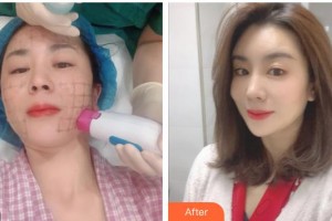 自貢華西友好醫(yī)院整形美容科崔熙允整形價(jià)格表附熱瑪吉案例展示