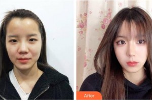 自貢尚美整形醫(yī)院鐘曉明整形價(jià)格表附膨體隆鼻案例展示