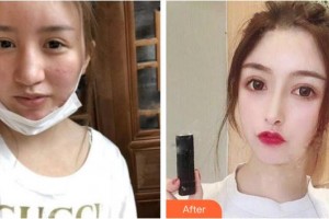 自貢市第四人民醫(yī)院整形美容科鐘俊波整形價(jià)格表附肋軟骨隆鼻案例展示