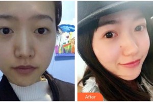 瀘州醫(yī)學(xué)院附屬醫(yī)院整形燒傷科廖毅 教授整形價(jià)格表附切開(kāi)雙眼皮案例展示