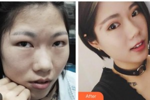 瀘州醫(yī)學(xué)院附屬醫(yī)院整形燒傷科熊愛(ài)兵整形價(jià)格表附切開(kāi)雙眼皮案例展示