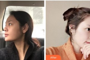 瀘州陳清整形美容醫(yī)院陳清整形價格表附假體隆鼻案例展示