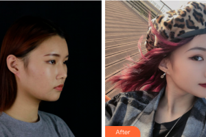 深圳美客華美醫(yī)療美容門診部袁耀東整形價(jià)格表附面部吸脂案例展示