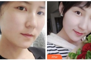 瀘州美馨醫(yī)學(xué)整形美容診所方峰整形價格表附埋線提升案例展示