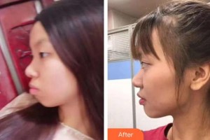 瀘州碧特牙科醫(yī)院陳戎整形價格表附金屬托槽矯正案例展示