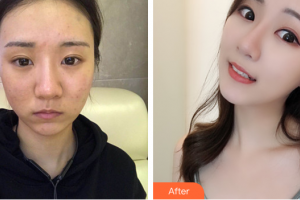 深圳美客華美醫(yī)療美容門診部陶宏偉整形價(jià)格表附面部吸脂案例展示