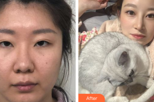 深圳臻瑞芝美醫(yī)療美容門診部林靖整形價(jià)格表附眼部修復(fù)案例展示