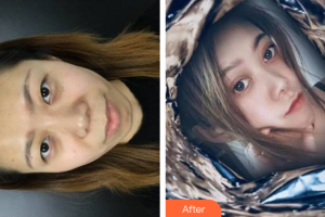 深圳瑞光醫(yī)療美容門診部蔣亦整形價(jià)格表附切開雙眼皮案例展示