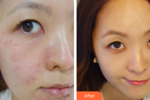 深圳瑞光醫(yī)療美容門診部陳亞軍整形價(jià)格表附果酸煥膚案例展示