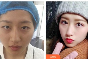 瀘州愛爾眼科醫(yī)院袁長明整形價格表附眼部綜合案例展示