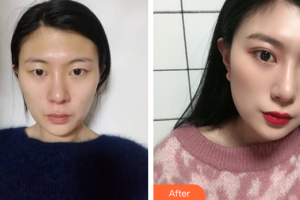 深圳恒生醫(yī)院整形美容中心陳兵整形價(jià)格表附眼部手術(shù)案例展示